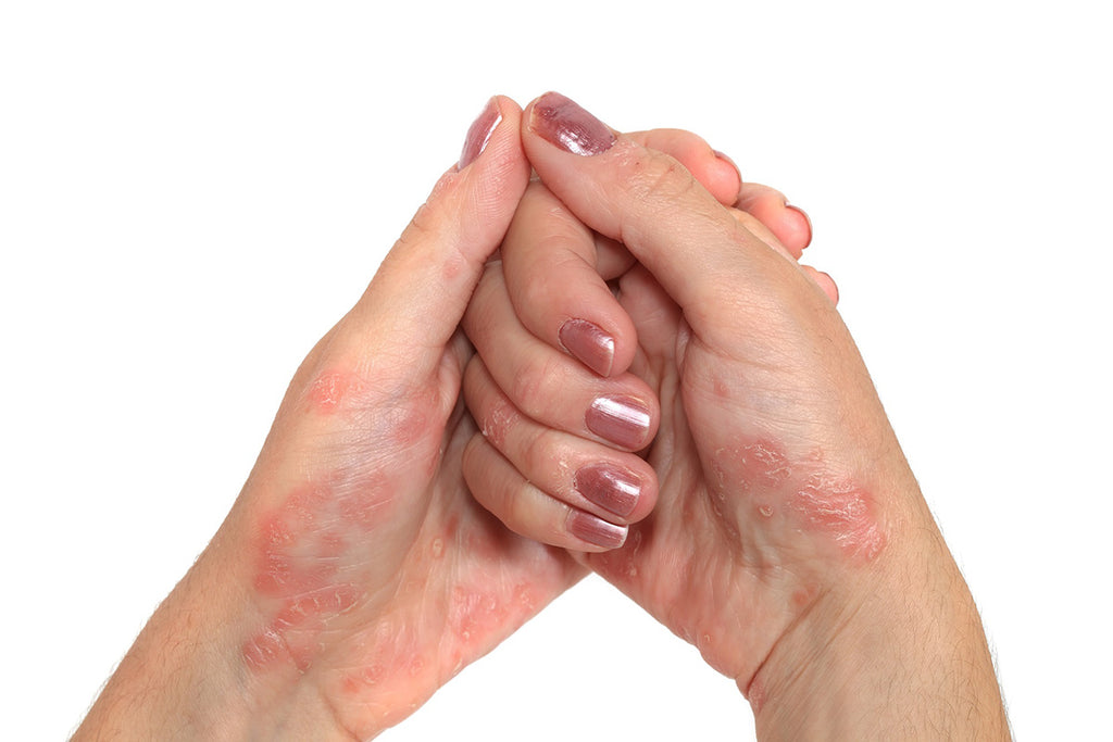 Remedies For Psoriasis and Eczema | Soho Acupuncture Center NYC